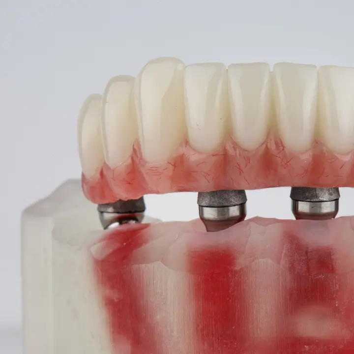 AnyConv.com__PROTESE